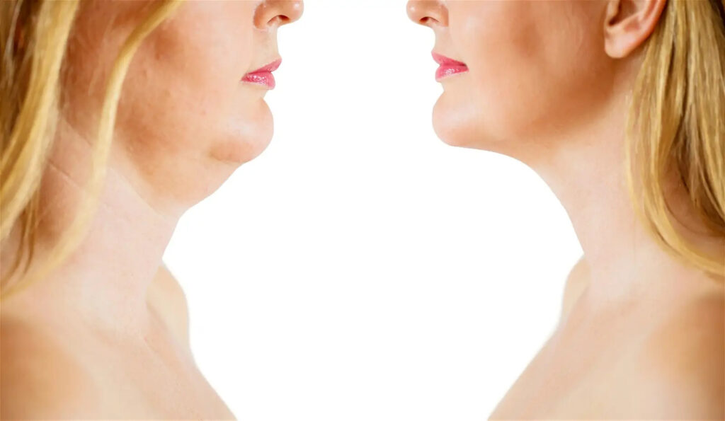 Kybella treatment